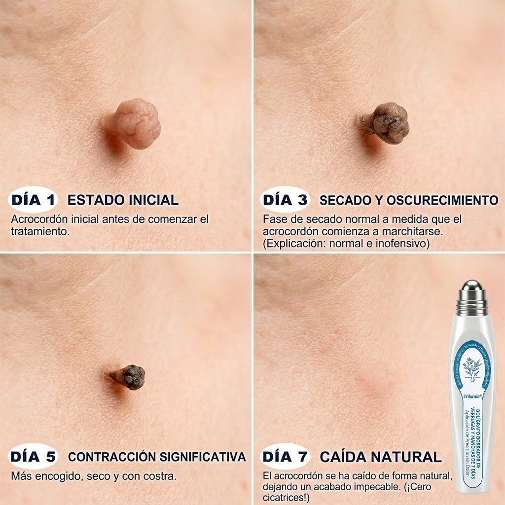🇲🇽 Tecnología de cuidado de la piel inspirada en dermatología | 🎲 Solución de cuidado para acrocordones y manchas en 7 días | 🖊️ Pluma avanzada con aplicador de precisión — Aplicación suave y resultados de piel con apariencia más uniforme
