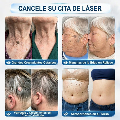 🇲🇽 Tecnología de cuidado de la piel inspirada en dermatología | 🎲 Solución de cuidado para acrocordones y manchas en 7 días | 🖊️ Pluma avanzada con aplicador de precisión — Aplicación suave y resultados de piel con apariencia más uniforme