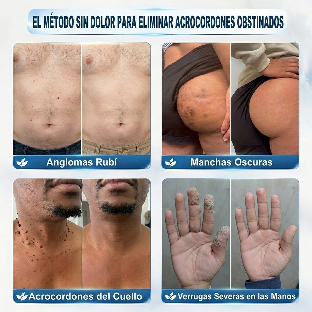 🇲🇽 Tecnología de cuidado de la piel inspirada en dermatología | 🎲 Solución de cuidado para acrocordones y manchas en 7 días | 🖊️ Pluma avanzada con aplicador de precisión — Aplicación suave y resultados de piel con apariencia más uniforme