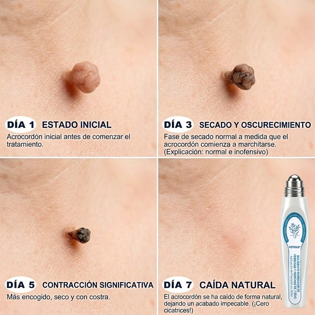 🛒 Trilumia® Eliminador de acrocordones y manchas en 7 días Pluma roll-on avanzada, sin dolor y sin dejar cicatrices