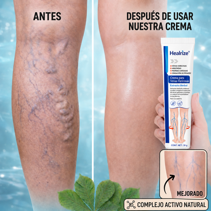 Healrize® Crema para Várices y Circulación – Piernas más ligeras y apariencia visiblemente mejorada